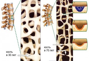 osteoporoz